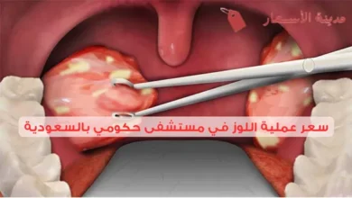 سعر عملية اللوز في مستشفى حكومي بالسعودية مقارنة بالمستشفيات الخاصة 2025 