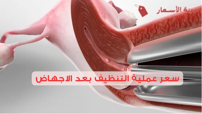 سعر عملية التنظيف بعد الاجهاض 2025 وما هو الفرق بين التنظيف الجراحي والشفط؟