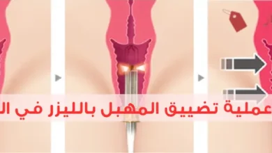كم سعر عملية تضييق المهبل بالليزر في الرياض 2025؟ أفضل العيادات في الرياض